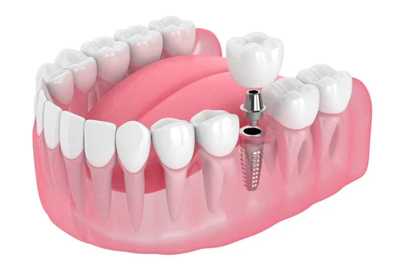 single dental implant